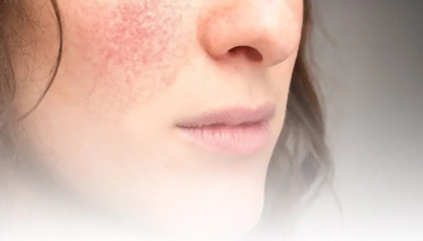 Närbild på en kvinna med rodnad på kinden, ett tecken på rosacea. Bilden visar hur man kan behandla rosacea.