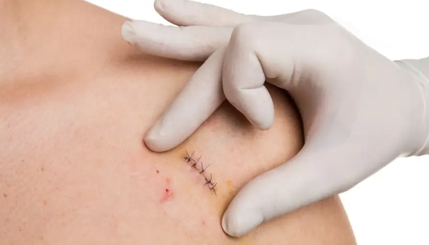 Main d'un professionnel en gant blanc examinant une plaie suturée, préparant l'ablation des points de suture.