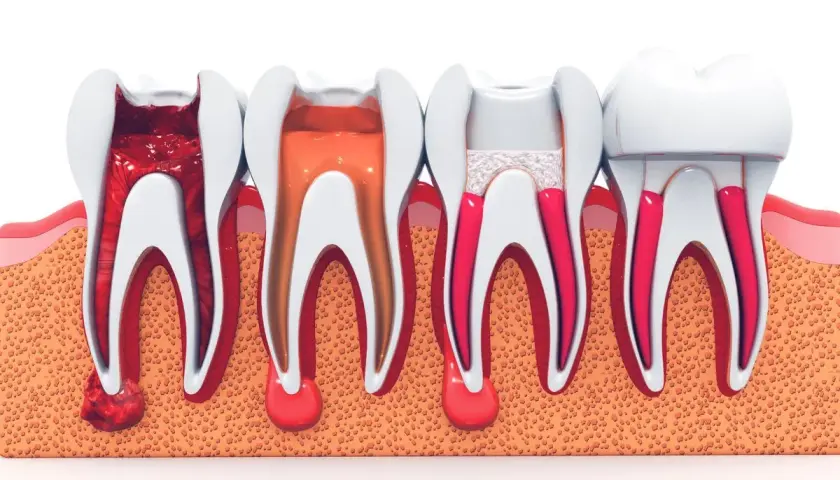 Ilustración de dientes con pulpectomia multirradicular, mostrando diferentes etapas de tratamiento endodóntico.