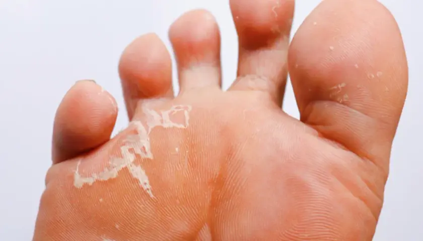 Le pied de l'athlète montre une peau qui pèle entre les orteils, signe d'une mycose.
