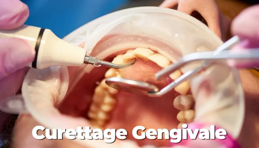 Dettaglio di una pulizia sottogengivale con strumento a ultrasuoni e specchietto dentale.