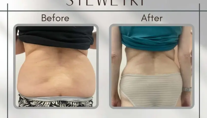 Liposukcja: co to? Modelowanie sylwetki, metody, ceny ekspert radzi