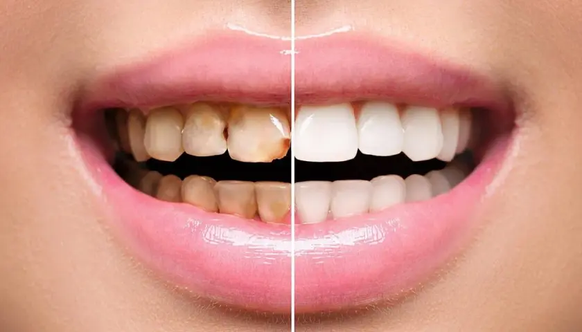Sorriso diviso: da denti ingialliti e con placca a bianchi e splendenti.