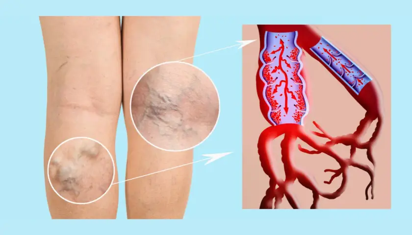 Piernas con várices y detalle de insuficiencia venosa, mostrando el flujo sanguíneo alterado en las venas.