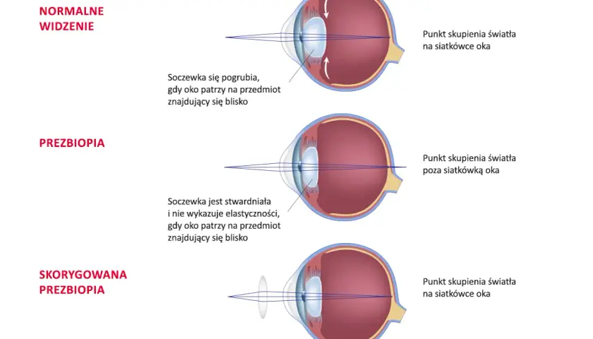 Ilustracja pokazuje, jak soczewka oka zmienia kształt przy patrzeniu z bliska. Przy prezbiopii soczewka jest stwardniała, co powoduje podwichnięcie punktu skupienia światła.