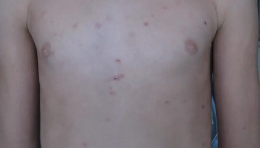 Torace con lesioni cutanee rosse e pruriginose, indicative di pitiriasi lichenoide cronica.