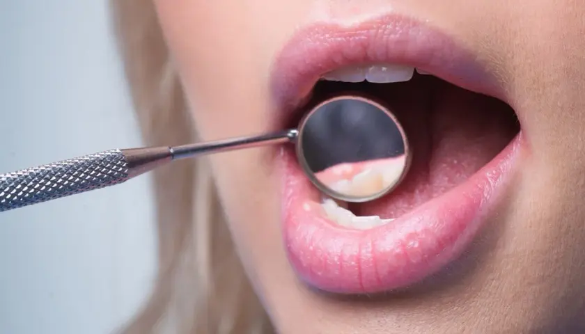 Usta kobiety z otwartymi zębami, w których odbija się lusterko dentystyczne. Widoczny brak szkliwa na zębach.