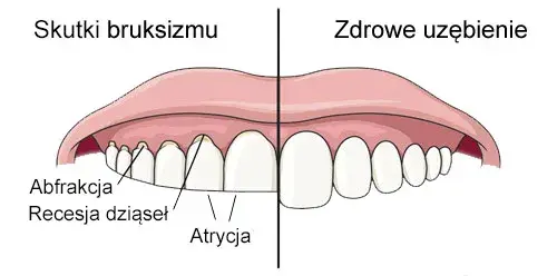 Co oznacza zgrzytanie zębami przez sen i jak temu zapobiec