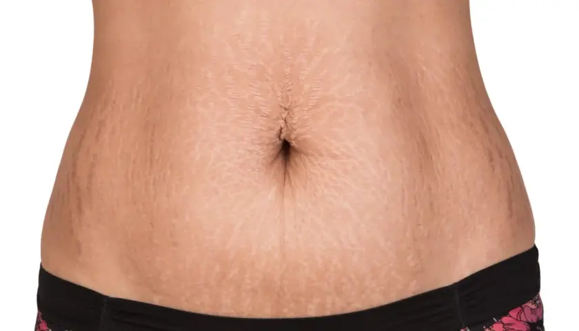 En mage med bristningar, en vanlig syn efter graviditet. Många väljer en mommy makeover för att återfå sin kropp.