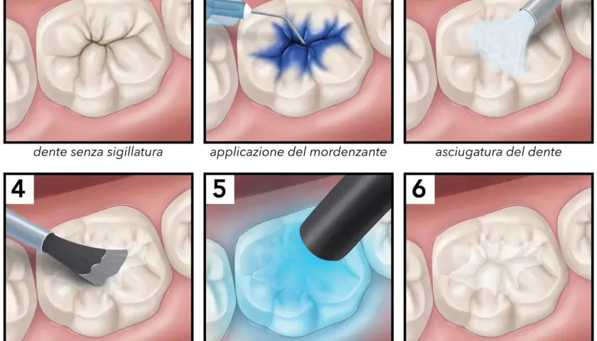 Illustrazione dei passaggi per sigillare i solchi dei denti, dalla preparazione all'applicazione del sigillante.