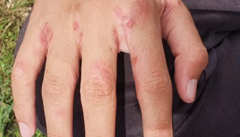 Här ser du hur skabb utslag kan se ut på händerna: små röda prickar och irriterad hud mellan fingrarna.