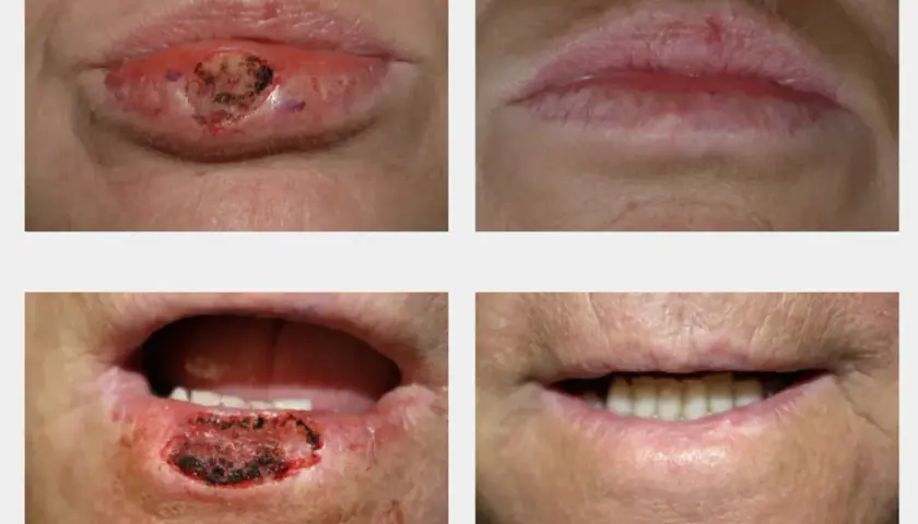 Cuatro imágenes muestran la evolución de un bulto en el labio, desde una lesión hasta la curación.