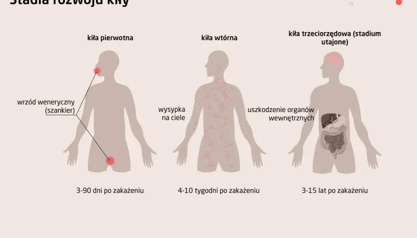 Ilustracja przedstawia stadia rozwoju kiły: pierwotna (wrzód), wtórna (wysypka) i trzeciorzędowa (uszkodzenie organów).
