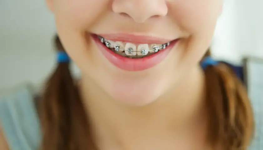 Sorriso di bambina con apparecchio ortodontico, un percorso verso un sorriso perfetto, con afte frequentissime.