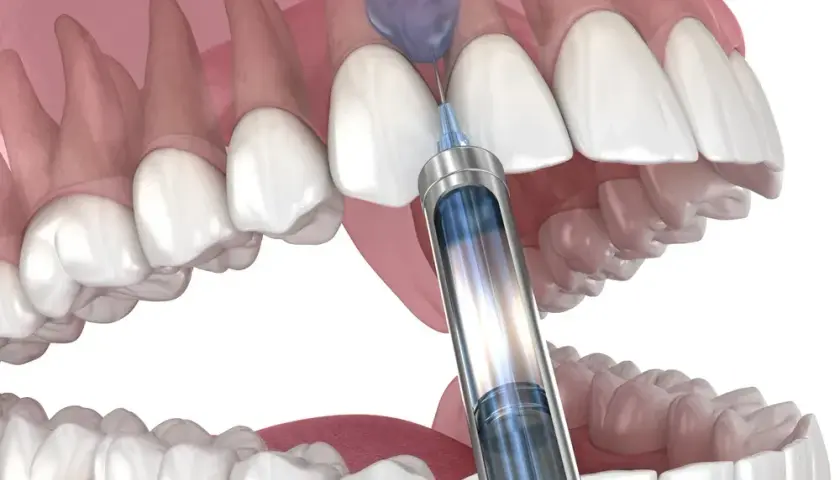 Jak długo działa znieczulenie u dentysty? Sprawdź, kiedy wróci czucie!