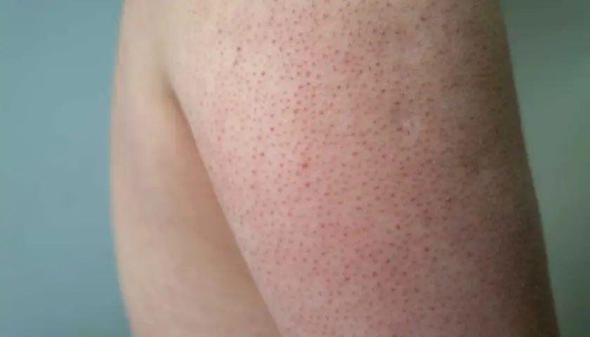 Närbild på hud med små röda prickar, typiskt för keratosis pilaris hos barn.