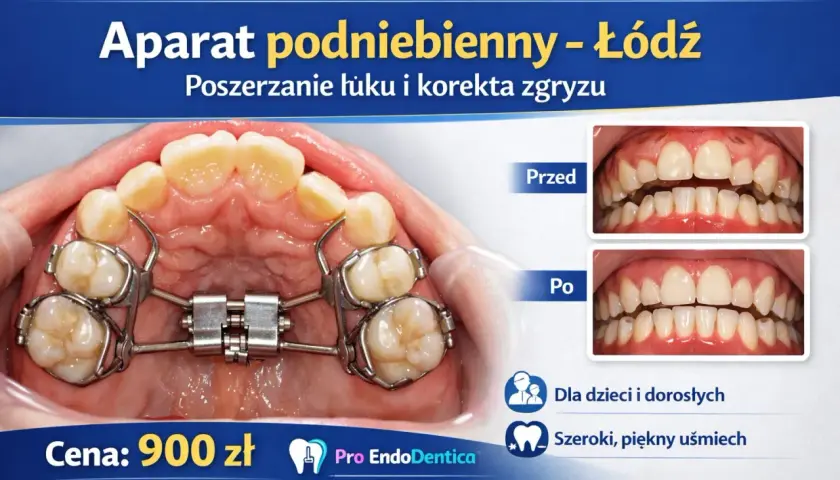 Aparat podniebienny w trakcie leczenia ortodontycznego. Zdjęcia "przed" i "po" pokazują korektę zgryzu.