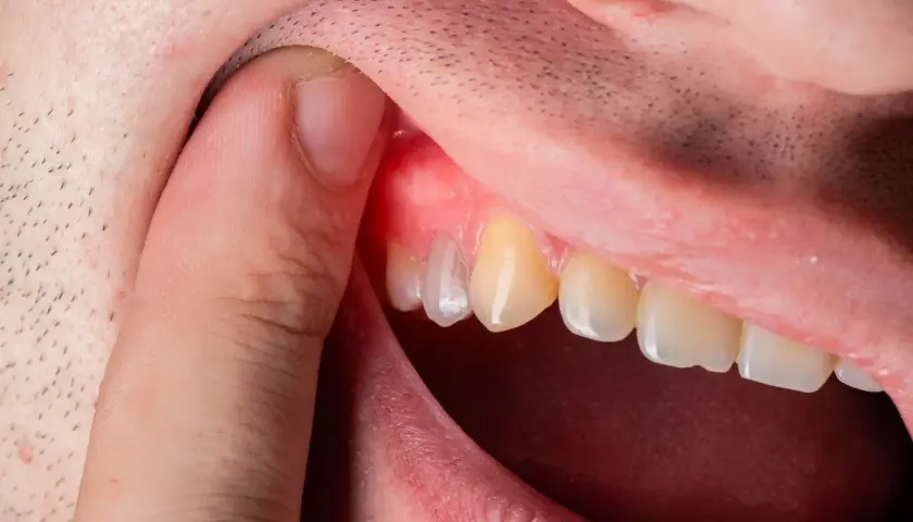 Gengiva arrossata e gonfia vicino a un dente, sintomo di un ascesso dentale. Quanto dura? Dipende dalla cura.