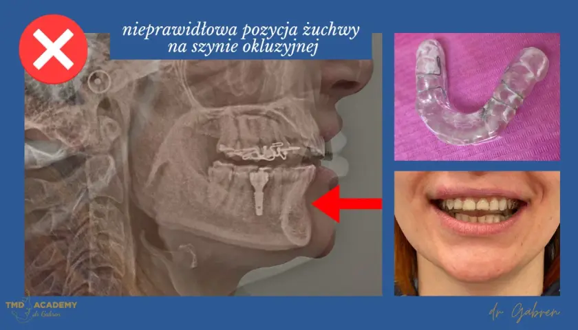 Rentgen żuchwy z nieprawidłową pozycją na szynie zgryzowej. Widoczna szyna i uśmiech pacjentki.