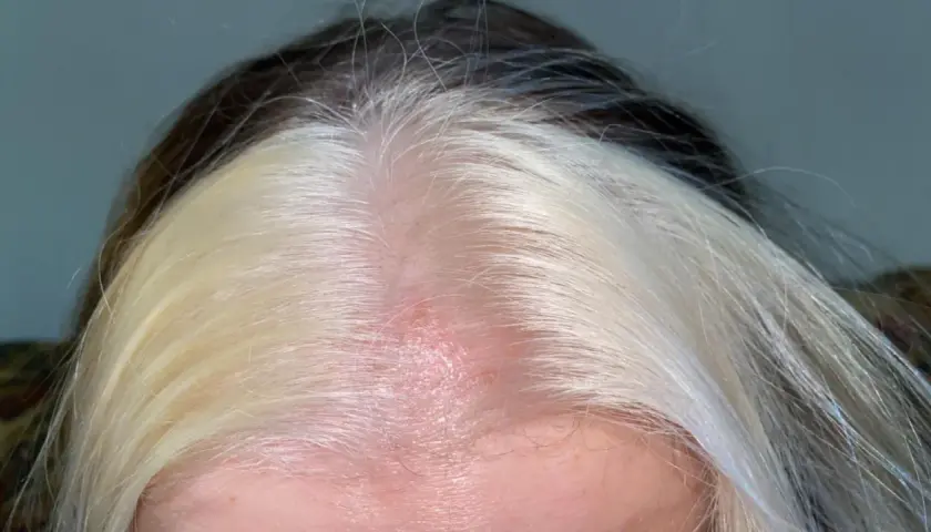 Cuero cabelludo enrojecido y con irritación, con mechones de cabello oscuro y rubio. Busca cómo curar quemaduras en el cuero cabelludo por decoloración.