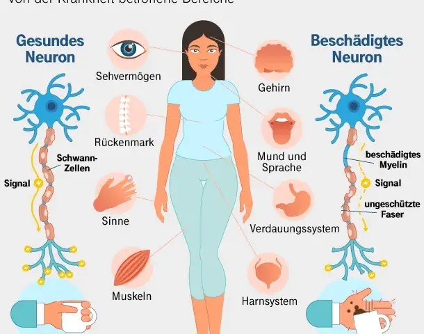Plötzlich multiple Sklerose: Die häufigsten Symptome und Beschwerden