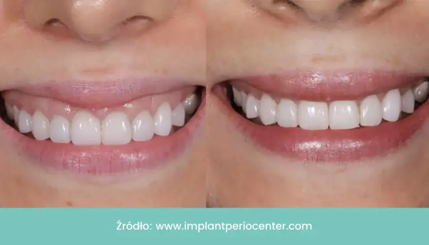 Uśmiech przed i po zabiegu redukcji uśmiechu dziąsłowego. Botoks skutecznie maskuje gummy smile.