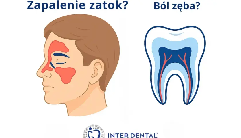 Zapalenie zatok czy ból zęba? Ilustracja przedstawia profil twarzy z zaznaczonymi zatokami oraz przekrój zęba z widocznymi nerwami.