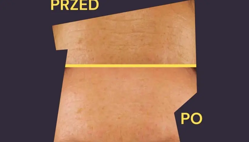 Przed i po: skóra z widocznymi zmarszczkami i przebarwieniami staje się gładsza i jaśniejsza. Kolagen na co pomaga? Wygładza i poprawia wygląd skóry.