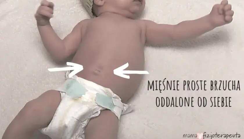 Rozejście mięśnia prostego brzucha u dziecka: objawy i leczenie.