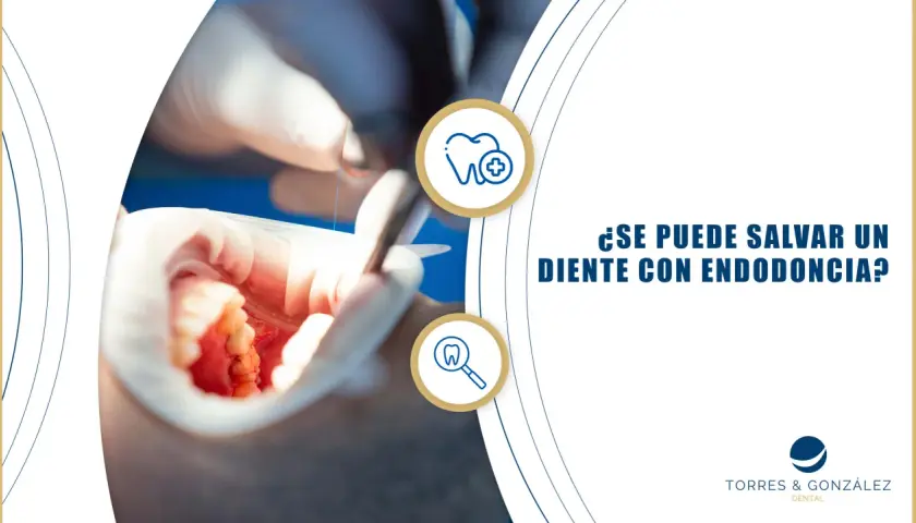 Procedimiento de endodoncia en un diente frontal. Dentista trabajando en la boca de un paciente.