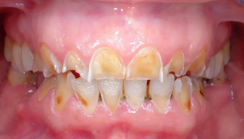 Denti ingialliti e consumati, con smalto eroso, un segno visibile degli effetti dell'anoressia sulla salute orale.