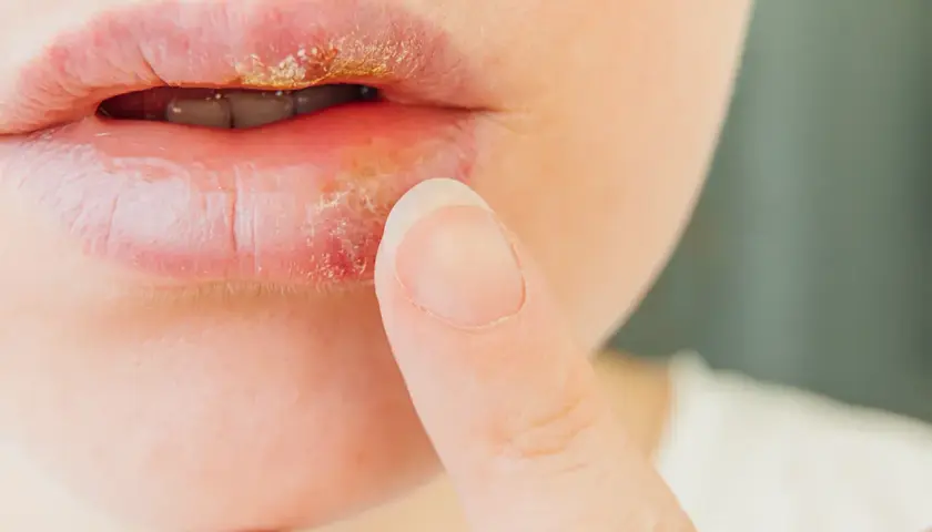 Labios con herpes labial, mostrando costras amarillentas y enrojecimiento. Un dedo se acerca a la zona afectada.