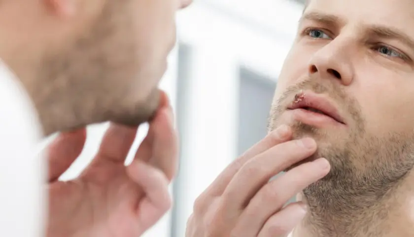 Mężczyzna z opryszczką na ustach zastanawia się, czy można iść do dentysty.