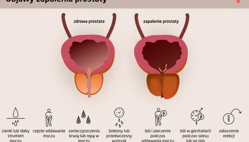 Porównanie zdrowej prostaty i zapalenia prostaty, z objawami takimi jak ból, problemy z oddawaniem moczu i zaburzenia erekcji.