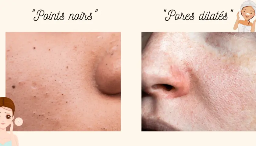 Comparaison de peau : points noirs et pores dilatés. Apprenez comment resserrer les pores pour une peau plus lisse.