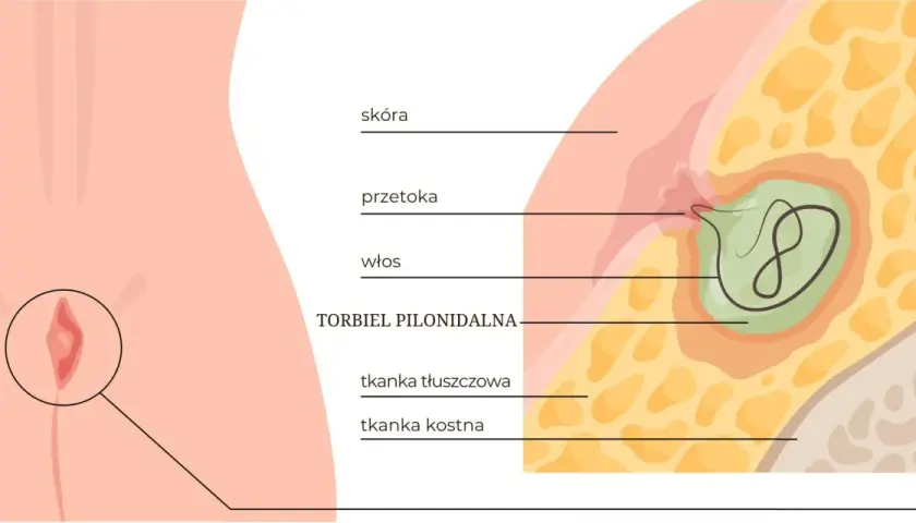Ilustracja przedstawia przekrój skóry z widoczną przetoką i włosem tworzącym torbiel pilonidalną.
