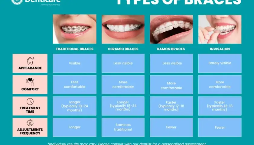 Porównanie rodzajów aparatów ortodontycznych: tradycyjne, ceramiczne, Damon i Invisalign. Tabela zawiera informacje o widoczności, komforcie, czasie leczenia i częstotliwości wizyt.