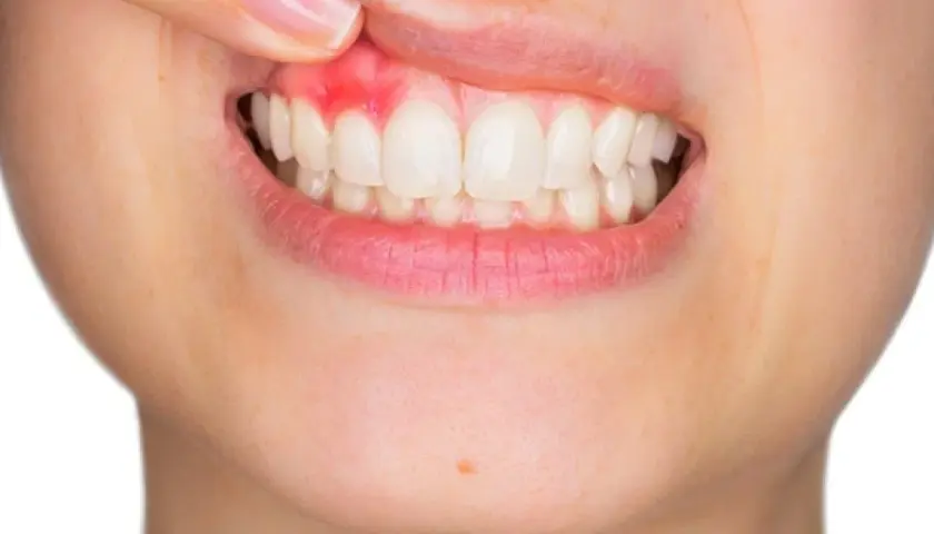 Encía inflamada y enrojecida, señal de periodontitis severa.
