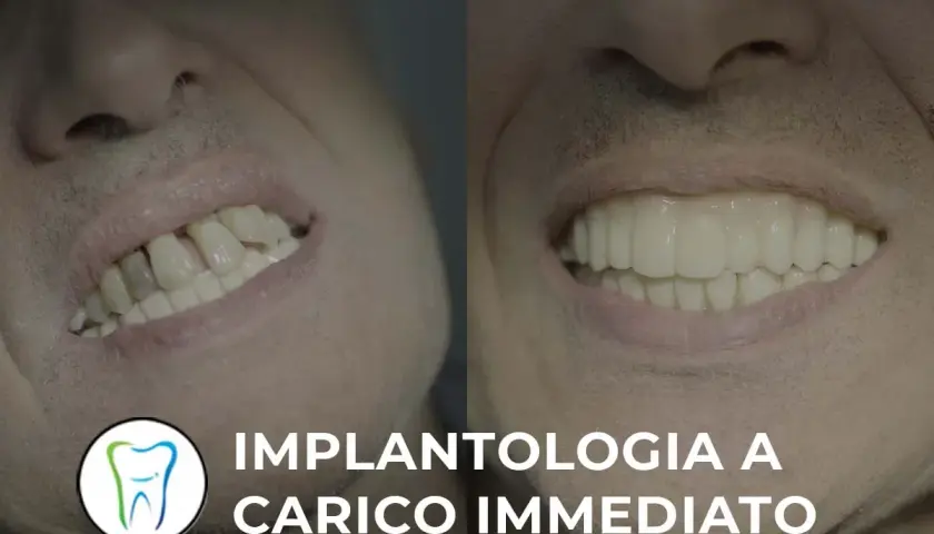 Prima e dopo: sorriso trasformato con implantologia a carico immediato. Valuta le controindicazioni per un risultato perfetto.