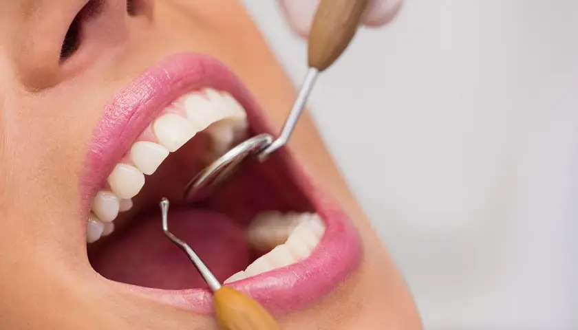 Usta kobiety z białymi zębami, badane przez dentystę. Widoczna jest niewielka kieszonka dziąsłowa.