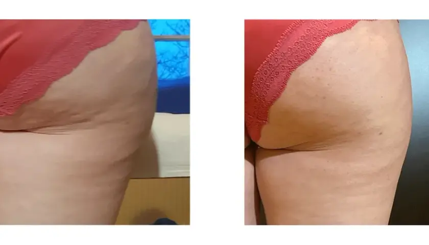 Endermologia: Redukcja cellulitu i modelowanie sylwetki czy to dla Ciebie?