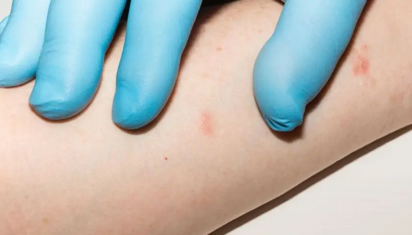Mano con guanto blu esamina piccole lesioni cutanee rosse su un braccio, indicative di psoriasi guttata nei bambini.