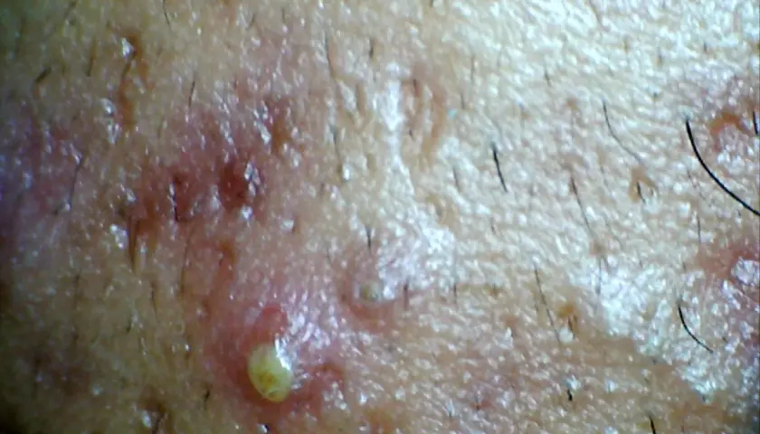 Primer plano de una pustula con pus amarillo, rodeada de piel enrojecida y vello oscuro.