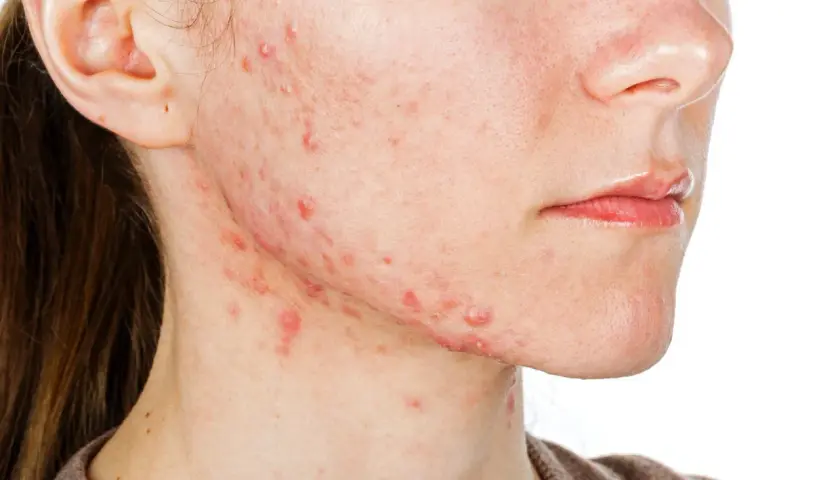 Visage avec acné légère sur la joue et le cou, une peau qui pourrait bénéficier de Roaccutane.