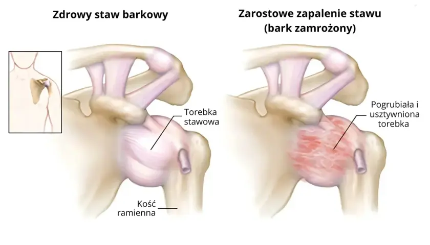 Porównanie zdrowego stawu barkowego z zapaleniem mięśnia barkowego (bark zamrożony), gdzie torebka stawowa jest pogrubiała i usztywniona.