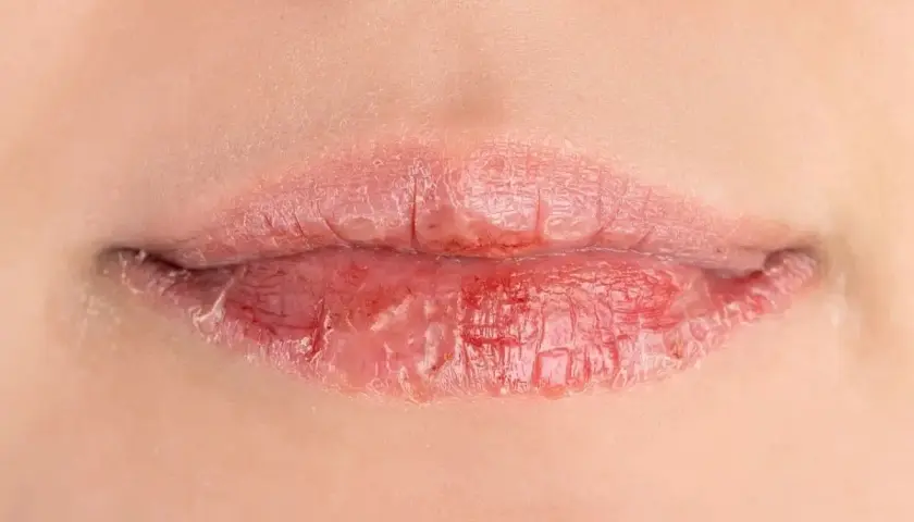 Labbra secche e screpolate, con pelle che si sfalda. Le cause possono essere molteplici, dal freddo alla disidratazione.
