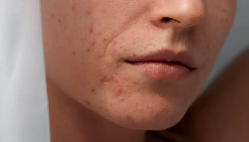 Gros plan sur le visage d'une femme montrant des imperfections et des rougeurs, typiques de l'acné de fin de grossesse.