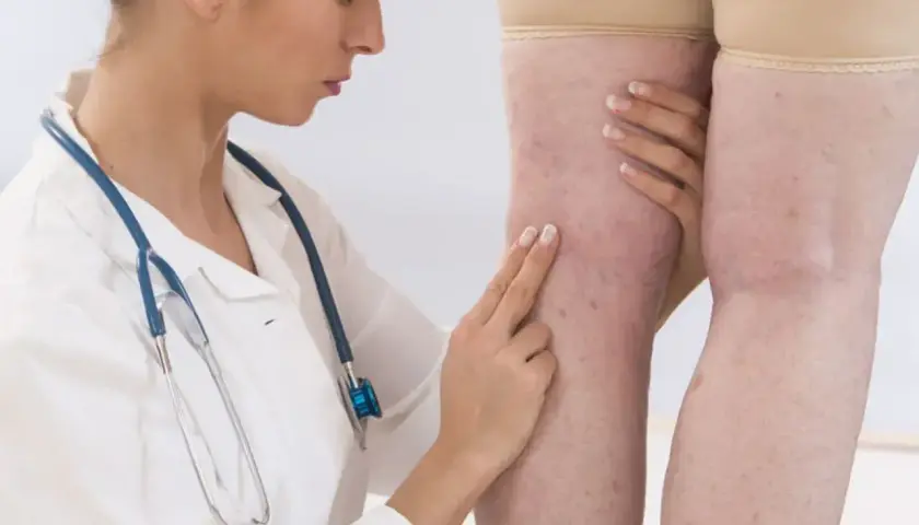 Lekarka bada nogi pacjentki z widocznymi żylakami i pajączkami. Dłonie lekarki delikatnie dotykają skóry, oceniając stan naczyń. D dimery mogą być badane w takich przypadkach.