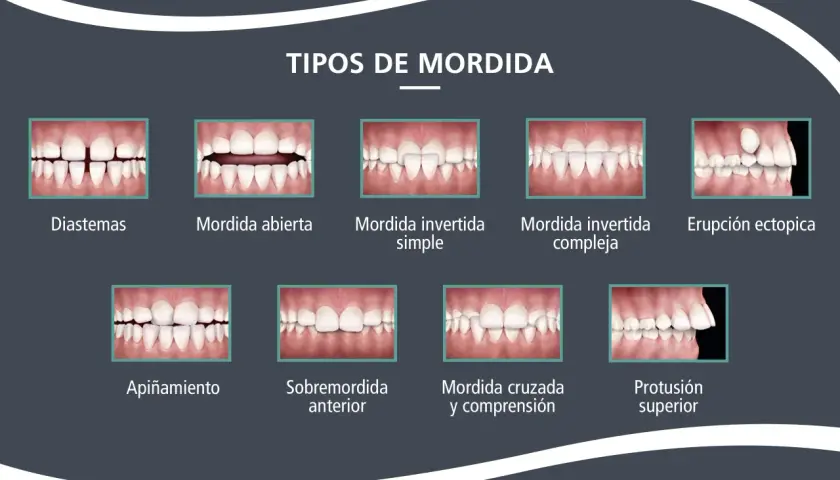 Ilustración de varios tipos de mordida dental, incluyendo una **mordida abierta** donde los dientes frontales no se tocan al cerrar la boca.