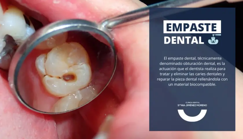 Reflejo en espejo dental de una muela con empaste, mostrando la cavidad tratada.
